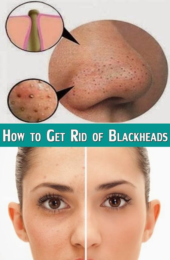 How to Get Rid of #Blackheads | #beauty tips