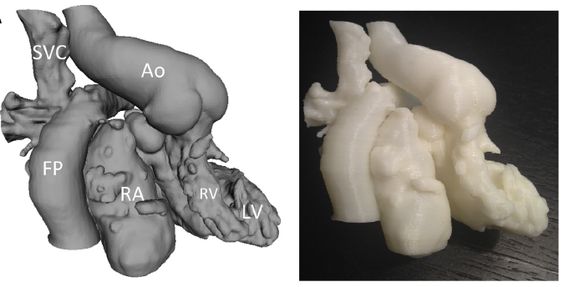 How 3D Printing Helps VAD Planning in Adults with CHD and Heart Failure