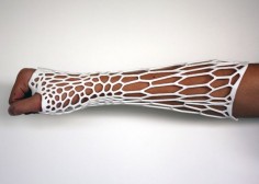 The Cortex cast prototype by designer Jake Evill heals fractured bones. The form of the cast varies with each case: 3-D scans are taken of the injury and used to determine the geometry and the distribution of the cast’s voronoi cells. The cells are denser in areas where the fracture is worse, requiring more support