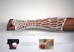3D Printed Cast Lets You Scratch And Wash